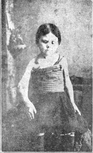 Ez a gyermek születésekor egészséges, normális gyermek volt. Másfél éves korában beoltották, ami után a szemei elkezdtek anyagot üríteni, és egy héten belül bezáródtak, és azóta vak.