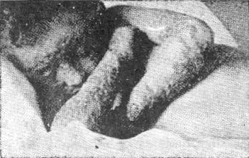 Ez a hatéves kisfiú általános vakcinózisban halt meg. Hathetes kora óta ekcémás volt. Mivel az ekcéma a szélsőséges toxémia (savasodás vagy belső mérgezés) állapota, az oltásszérumból származó méreg felerősítette a szervezet mérgezését, és 1949 szeptemberében meghalt. 1953 márciusában a bradfordi Dr. George Taylor beoltotta öt hónapos kislányát, aki enyhe ekcémában szenvedett, és a csecsemő kilenc nappal később általános vakcinózisban és ekcémában meghalt. Az orvosok kezdik belátni, hogy milyen súlyos dolog a már megmérgezett betegeket még több méreggel mérgezni az oltószérumok formájában.