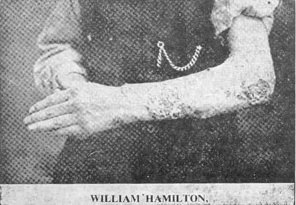 William Hamiltont három hónapos korában beoltották. A méreg elterjedt, és a sebek soha nem gyógyultak be. Az esetet hat orvos vizsgálta, de reménytelen esetként lemondtak róla. A karja a csecsemőkori oltás óta használhatatlan, A kép 15 éves korában készült.