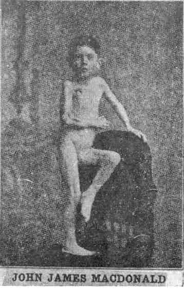 ohn James MacDonald jól volt és normális volt, amikor beoltották. Egy idő után az oltott karja elsorvadt és kihúzódott, amíg használhatatlanná nem vált. Aztán a jobb lába is lefogyott, és annyira meghúzódott, hogy már nem tudott járni. Az oltás nem volt hajlandó begyógyulni, ráadásul a lábán egy gennyes seb alakult ki.