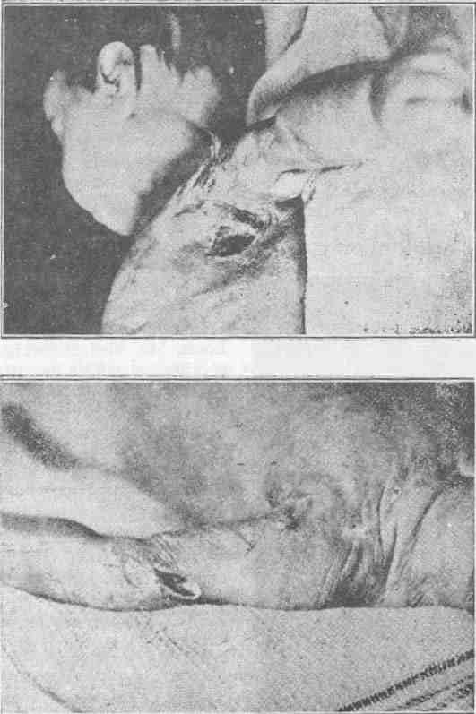 Ethel Mary Thompson, hét hónapos (Skene Row, Aberdeen) gyönyörű, egészséges csecsemő volt, amíg be nem oltották. Nem sokkal a műtét után fekélyek kezdtek kialakulni, amelyek soha nem gyógyultak be. Hat héttel később, amikor az orvost hívták, megfigyelte, hogy "egy nagy lyuk van" a karján, közvetlenül az oltás közelében, és egy másik tátongó seb a hónaljban. A hús ezen a területen addig bomlott, amíg a bordák szabadon nem maradtak. A hasán egy nagy barna, rothadó húsfolt volt, a térde pedig a normális méretéhez képest aránytalanul feldagadt. A lábujjakon gennyes sebek keletkeztek. A gyermek két hónapnyi mérhetetlen szenvedés után meghalt.