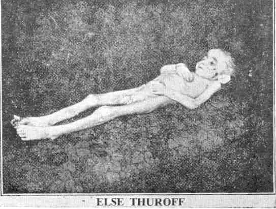 Elsie Thuroff 1920. március 3-án született, és 1921. június 8-án oltották be. Ugyanezen év augusztusában "heves csikorgó fájdalmaktól, valamint a karja csontjainak duzzanatától és torzulásától kezdett szenvedni egészen a válláig. Az orvosi diagnózis a csontok tuberkulózisa volt. Műtéten esett át, ami után az állapota folyamatosan rosszabbodott, míg a karja felhúzódott és tehetetlen lett.  Az arcbőre leégett. Az oltásnyomok elgennyesedtek, és a test élő csontvázzá sorvadt.  "Kínzó fájdalmak után 1923. január 8-án halt meg."